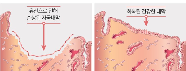 유산으로 손상된 자궁내막(좌)과 회복된 건강한 자궁내막(우)을 비교한 조직 단면 다이어그램