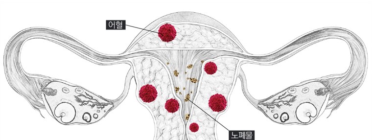 유산 후 자궁 내부에 남은 어혈(붉은 덩어리)과 노폐물을 표시한 자궁·난소 해부 다이어그램