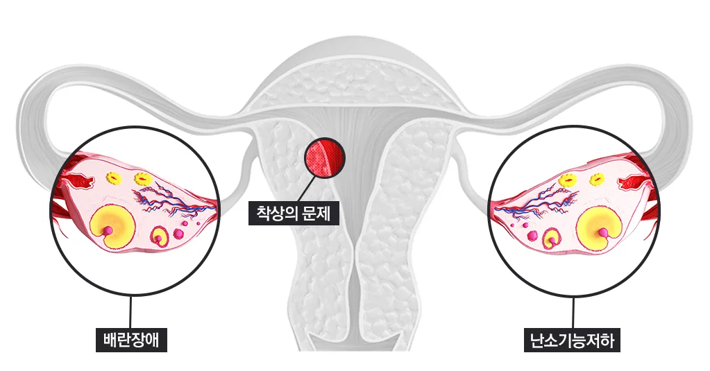 불임의 원인 — 배란장애 · 난소기능저하 · 착상의 문제