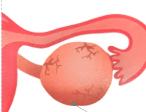 난소낭종이 발생한 난소 일러스트