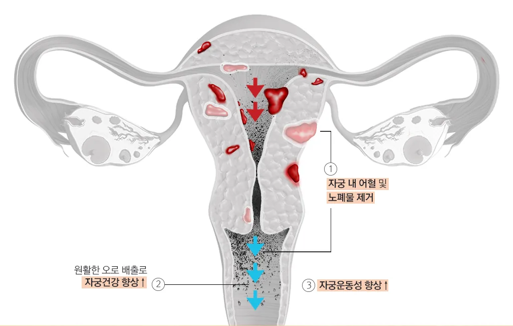 자궁 내 어혈·노폐물 제거 다이어그램 — 디톡스 약침