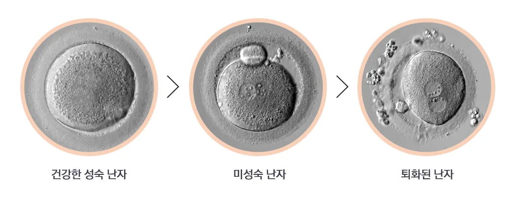 난자 상태 비교