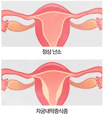 정상 난소와 자궁내막증식증 비교