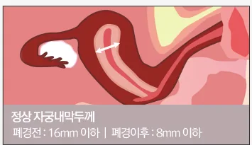정상 자궁내막두께: 폐경전 16mm 이하, 폐경이후 8mm 이하