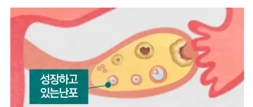 정상 난소 — 성장하고 있는 난포