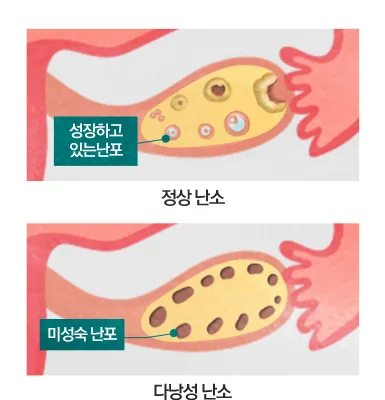 정상 난소(성장하고 있는 난포)와 다낭성 난소(미성숙 난포) 비교 다이어그램