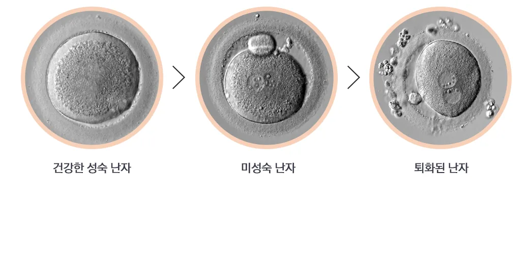 난소기능강화 · 배란 정상화