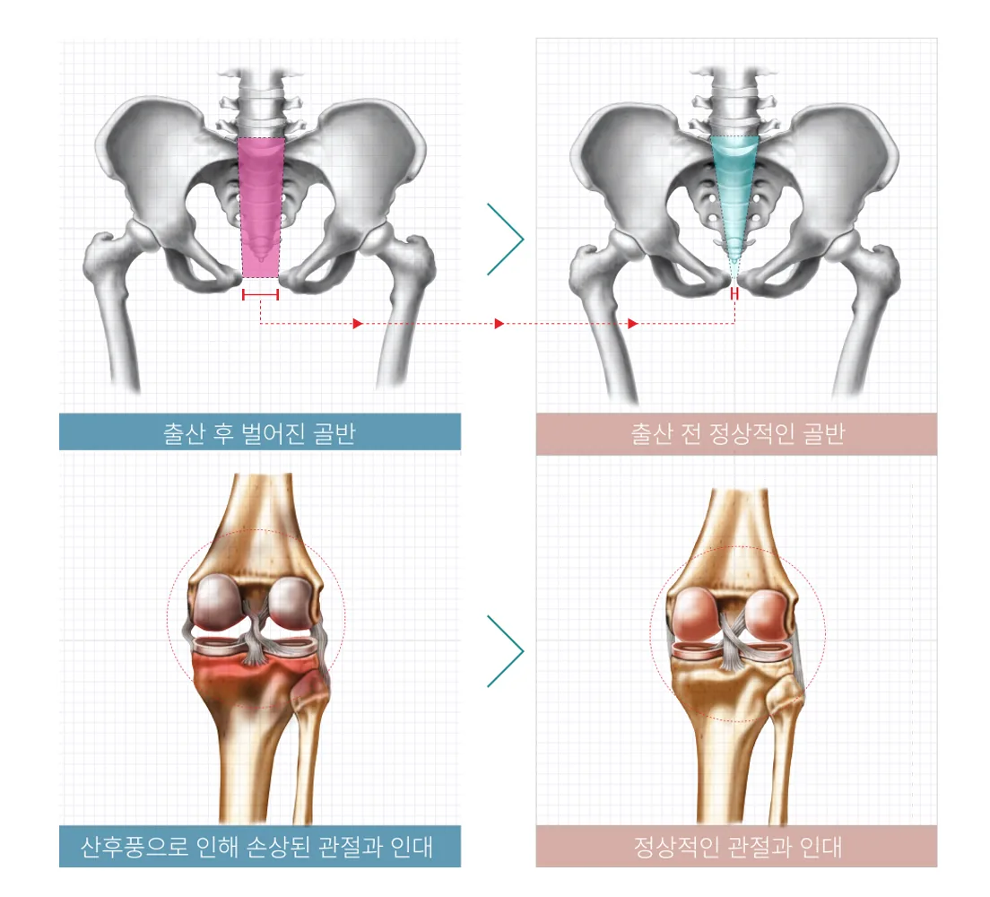 출산 후 벌어진 골반 → 출산 전 정상적인 골반 / 산후풍으로 인해 손상된 관절과 인대 → 정상적인 관절과 인대