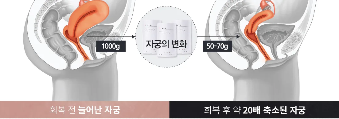 자궁의 변화 — 회복 전 늘어난 자궁(1000g)에서 회복 후 약 20배 축소된 자궁(50-70g)으로