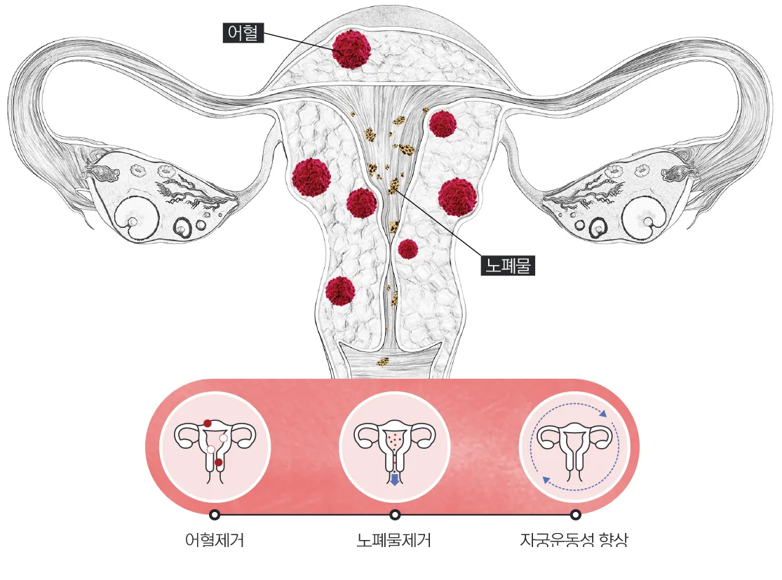 자궁 내 어혈과 노폐물 도해 — 어혈제거 · 노폐물제거 · 자궁운동성 향상