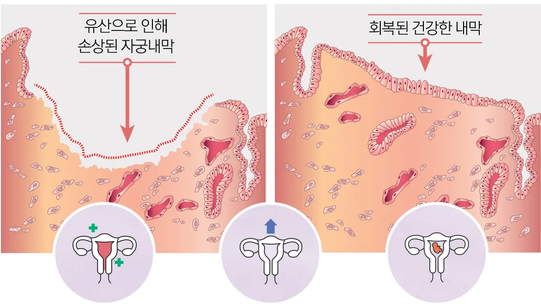유산으로 인해 손상된 자궁내막 → 회복된 건강한 내막