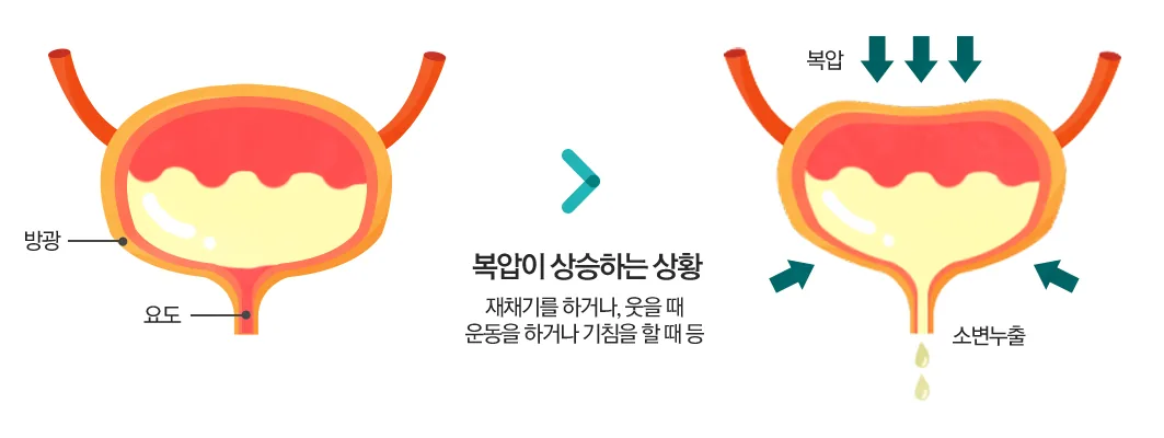 복압성 요실금 도해 — 복압이 상승하는 상황에서 소변 누출