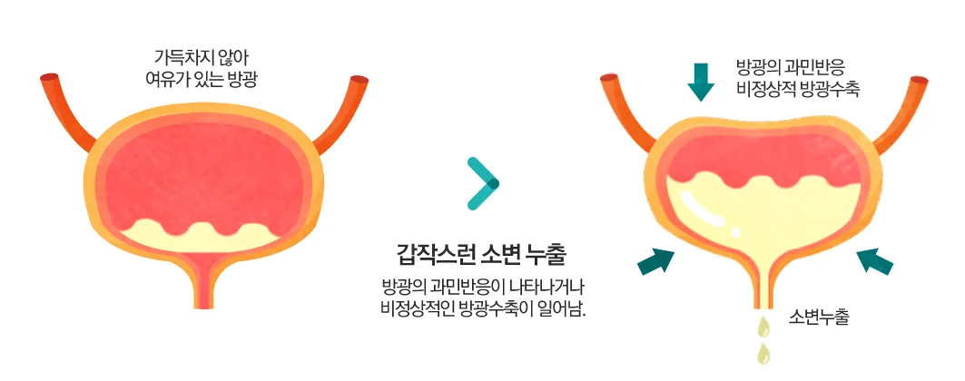 절박성 요실금 도해 — 방광의 과민반응·비정상적 방광수축으로 갑작스런 소변 누출